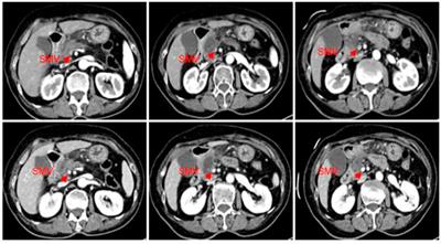 Case report: A case study on the treatment using icaritin soft capsules in combination with lenvatinib achieving impressive PR and stage reduction in unresectable locally progressive pancreatic cancer and a literature review